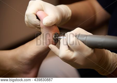 Close-up Of A Foot Peeling Procedure From Calluses On The Feet By The Podiatrist Hands In White Prot