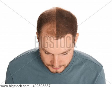 Man With Hair Loss Problem Before And After Treatment On White Background, Collage. Visiting Trichol