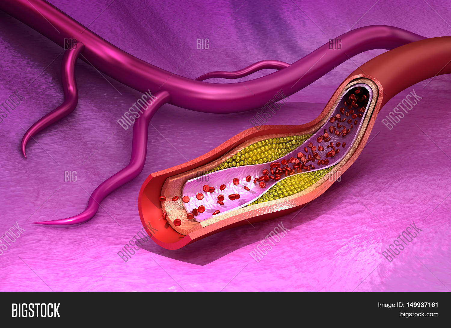 Cholesterol Plaque Image & Photo (Free Trial) Bigstock