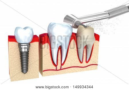 Dental crown implant and teeth 3d image .