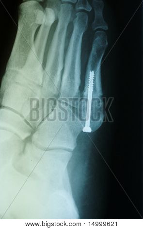 Jones Fracture Repair