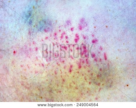Bruised Wound Injury On Human Body. Patient Show Injured Body With Large Paintful Hematoma.
