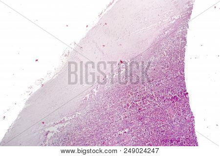 Splenic Capsule Hyaline Degeneration, Light Micrograph, Photo Under Microscope