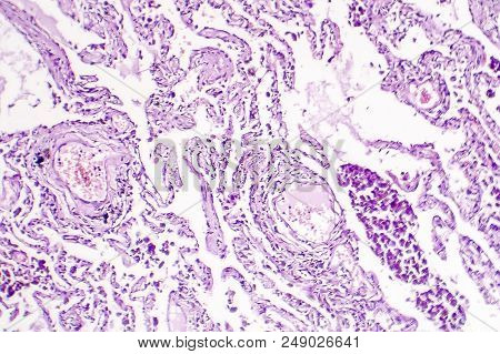 Chronic Pulmonary Congestion, Light Micrograph. Photo Under Microscope