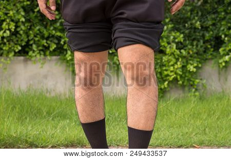 Asian Man Leg Bandy-legged Shape Of The Legs