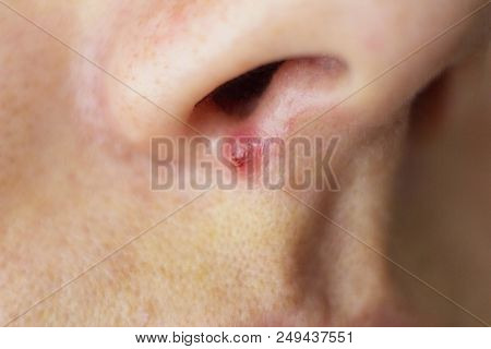 Pimple On The Face Of The Girl Near The Nose, Whelk