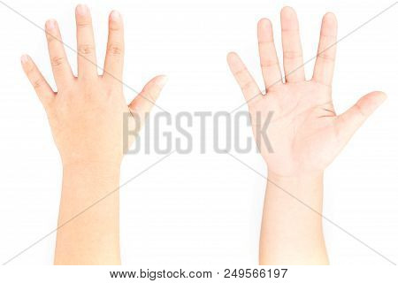 Hand Bones Injury White Background Hand Pain