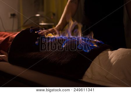 Chinese Fire Massage - Huo Liao Therapy. Traditional Chinese Medicine, Fire Treatment And Bodycare C