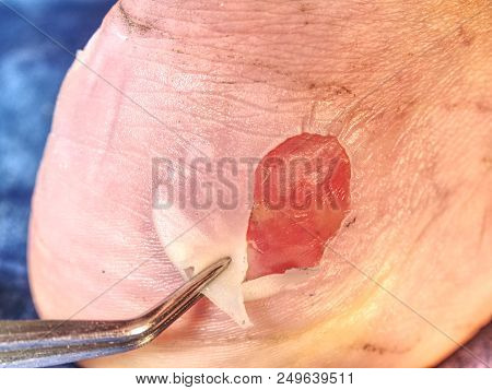 Nasty Burned Wound. Removing Of Burned Skin From Attached Place At Achilles Tendon.