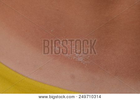 Sunburn On The Skin Of The Back. Exfoliation, Skin Peels Off. Dangerous Sun Tan