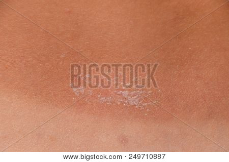 Sunburn On The Skin Of The Back. Exfoliation, Skin Peels Off. Dangerous Sun Tan