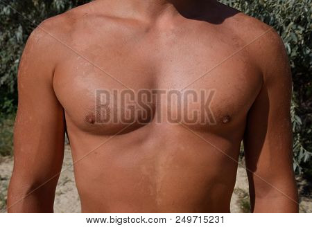 Sunburn On The Skin Of The Chest And Abdomen Of A Man. Exfoliation, Skin Peels Off. Dangerous Sun Ta
