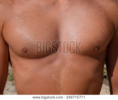 Sunburn On The Skin Of The Chest And Abdomen Of A Man. Exfoliation, Skin Peels Off. Dangerous Sun Ta