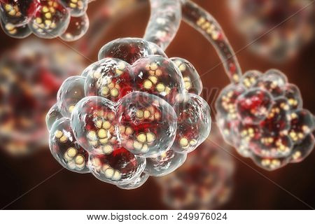 Pneumococcal Pneumonia, Medical Concept. 3d Illustration Showing Bacteria Streptococcus Pneumoniae I