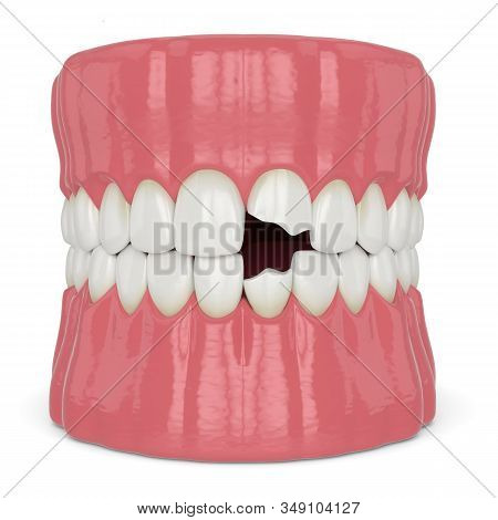 3d Render Of Jaw With Broken Incisors Teeth Over White Background