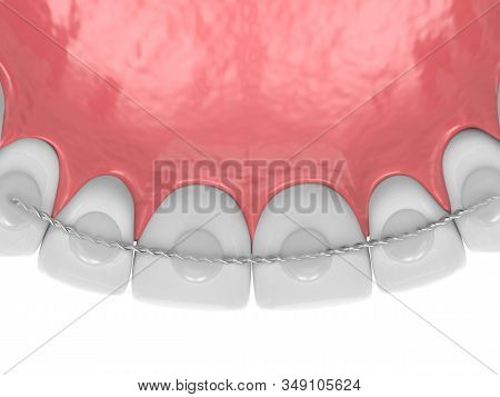 3d Render Of Dental Bonded Retainer On Upper Jaw Over White Background