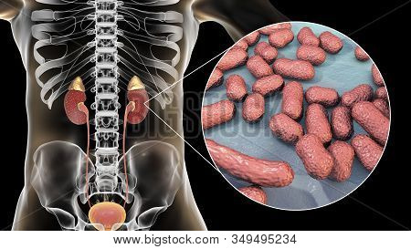 Acute Pyelonephritis Caused By Bacteria Acinetobacter Baumannii, Medical Concept, 3d Illustration