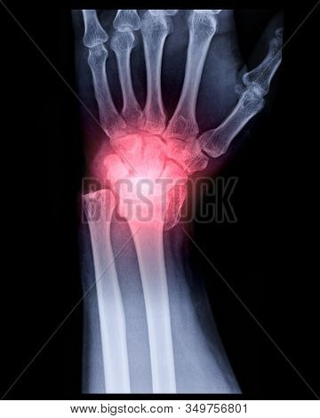 X-ray Image Of Left Wrist Joint Ap View For Showing Fracture Of Radius Bone.