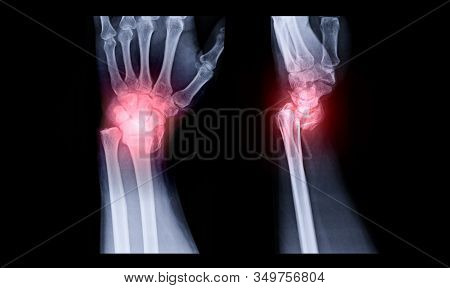 X-ray Image Of Left Wrist Joint Ap And Lateral View For Showing Fracture Of Radius Bone.