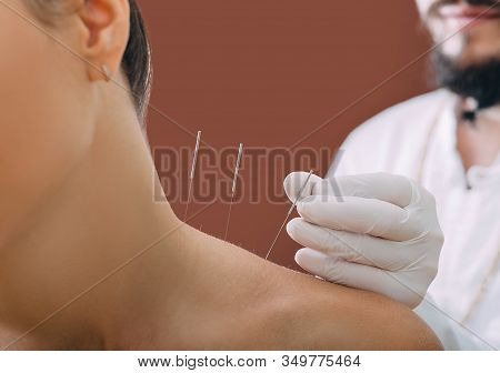 Needles For Acupuncture In A Womans Shoulder Close-up On A Brown Background. A Reflexologist Very Ac