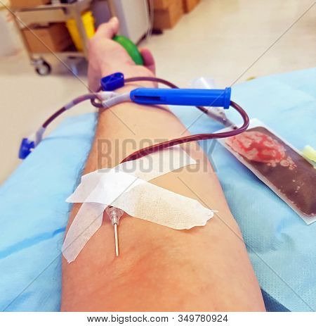 Blood Donor Arm During Plasmapheresis In A Hospital Facility And The Needle Penetrated Into The Skin