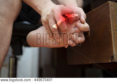 Man With Painful And Inflamed Gout On His Foot Around The Big Toe Area.