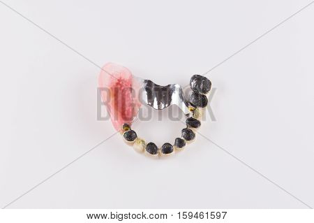 Clasp prosthesis with and attachments fixing ceramic crowns