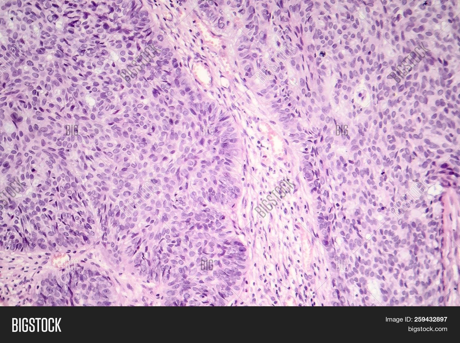 Basal Cell Carcinoma, Image & Photo (Free Trial) Bigstock