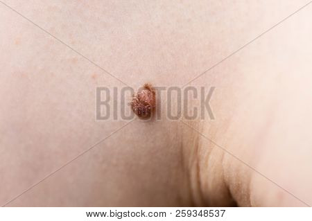 Unrecognizable Person Having Dark Fibroma, Dermatology Problem On Skin. Close Up Of Papilloma Dermat