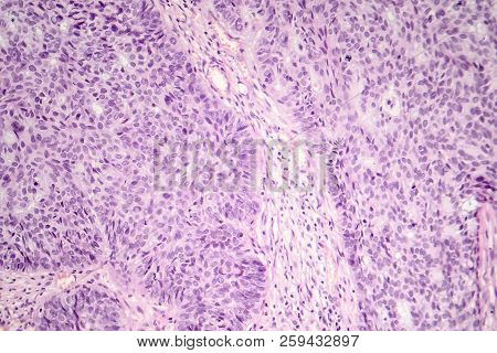 Basal Cell Carcinoma, Skin Cancer, Light Micrograph, Photo Under Microscope