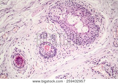 Basal Cell Carcinoma, Skin Cancer, Light Micrograph, Photo Under Microscope