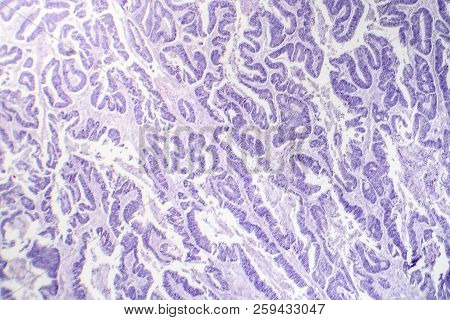 Esophageal Squamous Cell Carcinoma, Light Micrograph, Photo Under Microscope