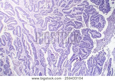 Esophageal Squamous Cell Carcinoma, Light Micrograph, Photo Under Microscope