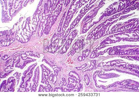 Colon Adenocarcinoma, Light Micrograph, Photo Under Microscope