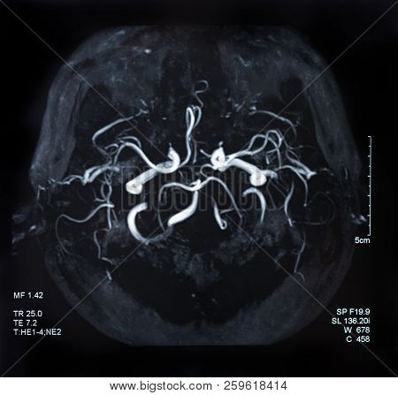 Mri Of The Brain Stroke And Cerebrovascular Disease. Brain X-ray Image.