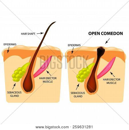 Open Comedones. Black Head Acne. The Structure Of The Skin. Infographics. Vector Illustration On Iso