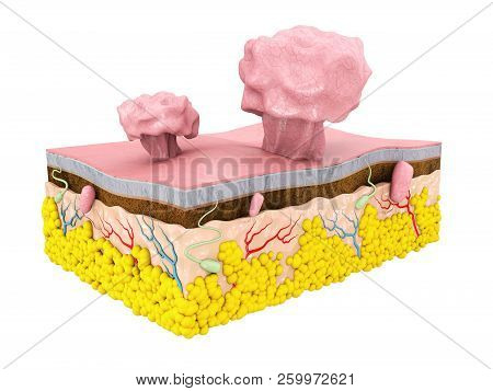 3d Illustration Of Polype With Skin Structure, Isolated White Background