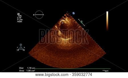 Image Of The Heart In Gray-scale Mode During Transesophageal Ultrasound.