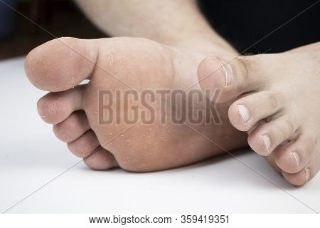 Fungus On The Leg Close-up Isolated On A White Background. The Concept Of Dermatology, The Treatment