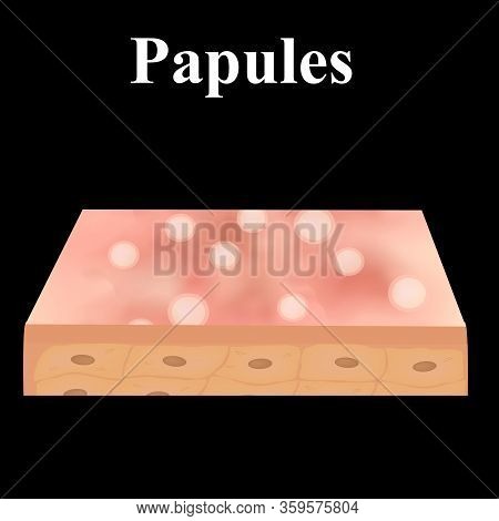 Papules. Acne On The Skin. Dermatological And Cosmetic Diseases On The Skin Of The Face Acne. Infogr
