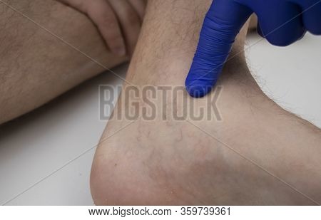 A Man In Consultation With A Vascular Surgeon. A Doctor Examines A Leg With Swollen Veins. Varicose