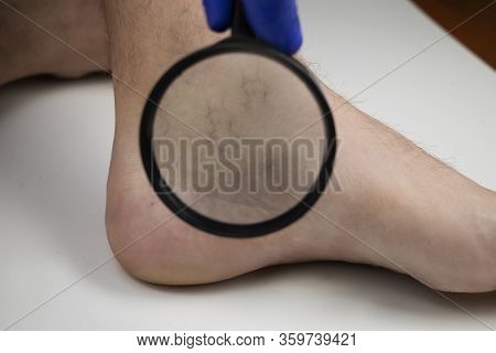 A Man In Consultation With A Vascular Surgeon. A Doctor Examines A Leg With Swollen Veins. Varicose