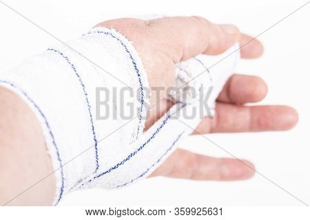 Chemical Burn On The Wrist Skin With Hydroxide Sodium Acid. Festering And Deep Wound. Household Acci