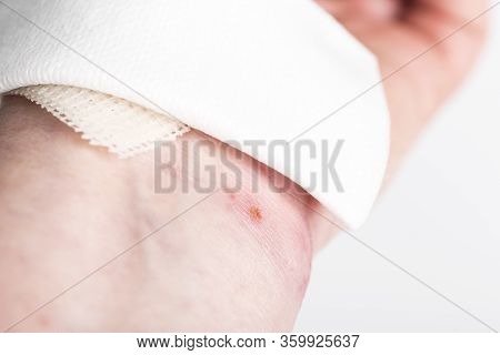 Chemical Burn On The Wrist Skin With Hydroxide Sodium Acid. Festering And Deep Wound. Household Acci