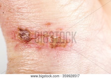 Chemical Burn On The Wrist Skin With Hydroxide Sodium Acid, By Striping Paint From Wood. Festering A