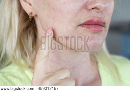 Real Skin Biorevitalization On White Background. Traces Of Biorevitalization Injections On Woman Fac