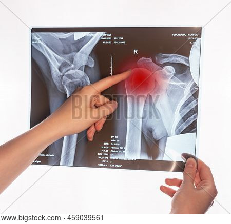 Forefinger Pointing To Trauma At Arm X-ray Image With Red Point. Acromion, Acromial End Fracture. Do