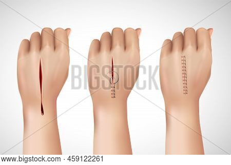 Surgical Suture Stitches Realistic Composition With Isolated Images Of Human Hand At Different Stage