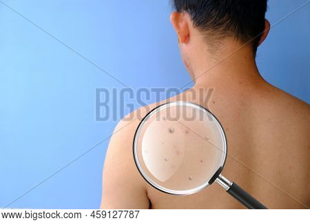 Health Problems, Skin Disease, Young Man Reappears With Acne, Monkeypox Is A New And Dangerous Disea