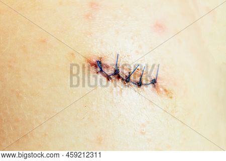 Stitched Wound And Medical Suture, Close-up. Medical Sutures After Operations, Sewn Surgical Sutures